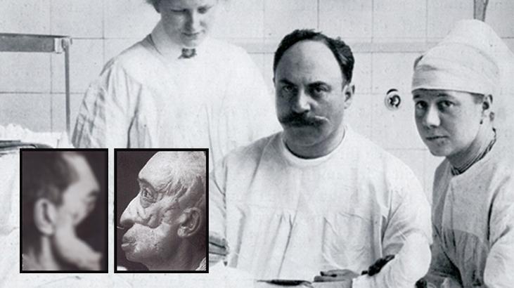 Türk asker yüzünü Çanakkale’de kaybetti! ‘Buruncu Joseph’ mucizeler yarattı